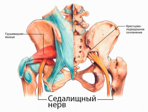 ишиас или невралгия