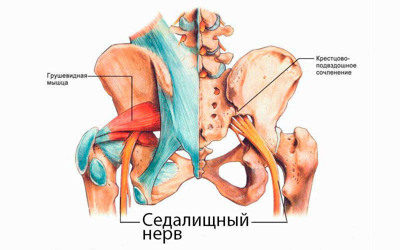 ишиас или невралгия