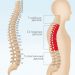 грыжа диска грудного отдела