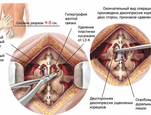 Что такое межпозвоночная грыжа и зачем ее удалять