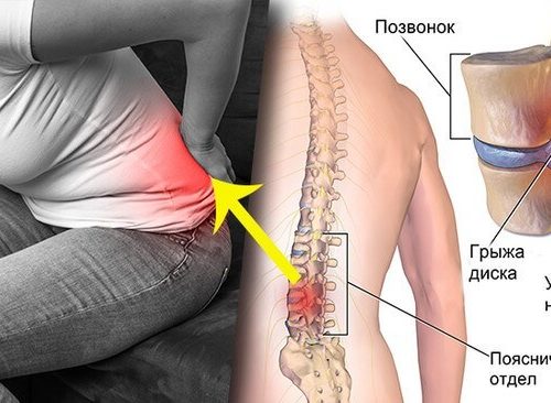 симптоматика межпозвоночной грыжи в поясничном отделе