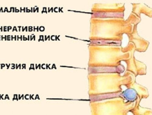 протрузия