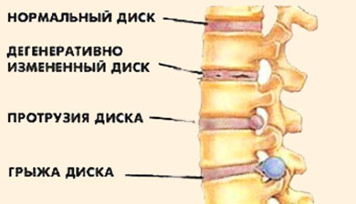 протрузия